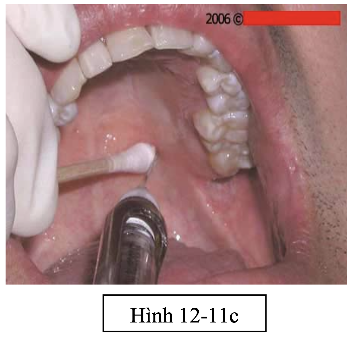 Tiểu phẫu răng khôn hàm trên